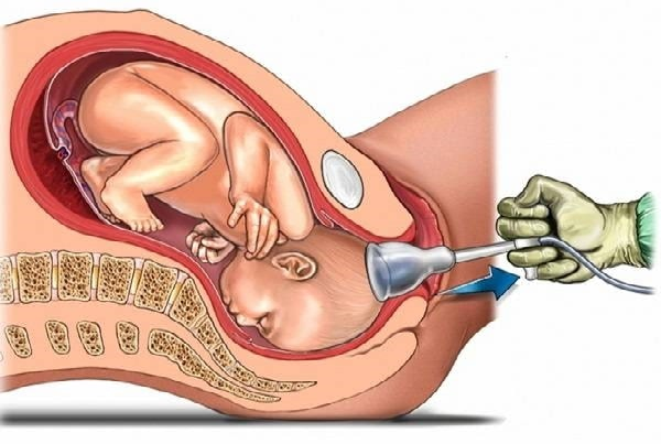 Forceps and Vacuum Delivery