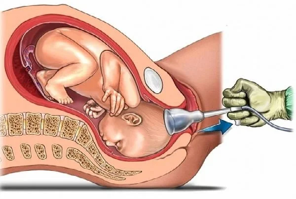 Forceps and Vacuum Delivery