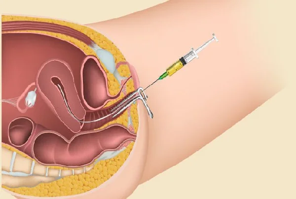IUI Procedure