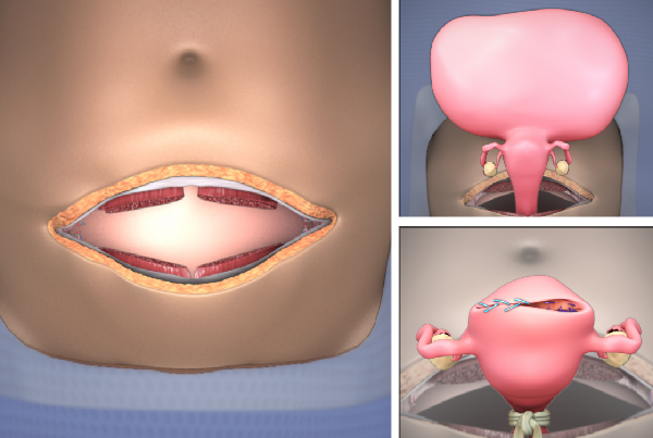 Myomectomy